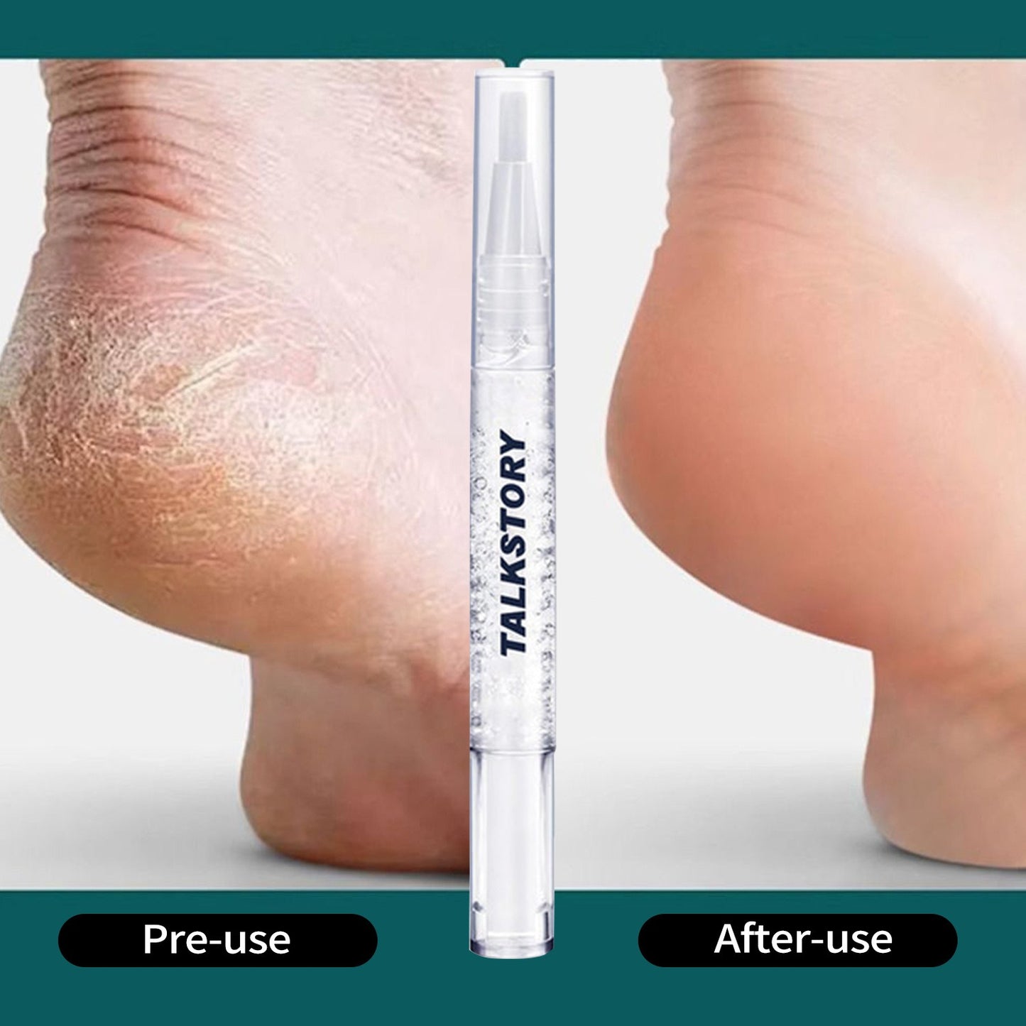 Antifungal Pen